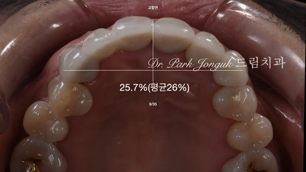 잇몸까지 상한 올세라믹 크라운과 브릿지의 재시술 방법은? 본문 사진 4