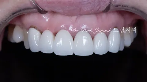 잇몸까지 상한 올세라믹 크라운과 브릿지의 재시술 방법은?