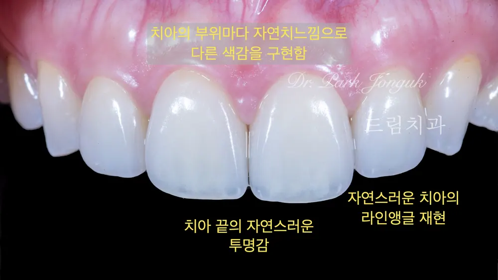 어색한 라미네이트, 내 치아처럼 보이고 싶다면? 본문 사진 19