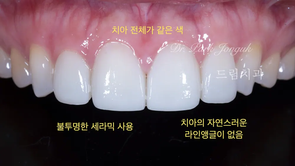어색하고 부자연 스러운 라미네이트 재시술 하기 본문 사진 5