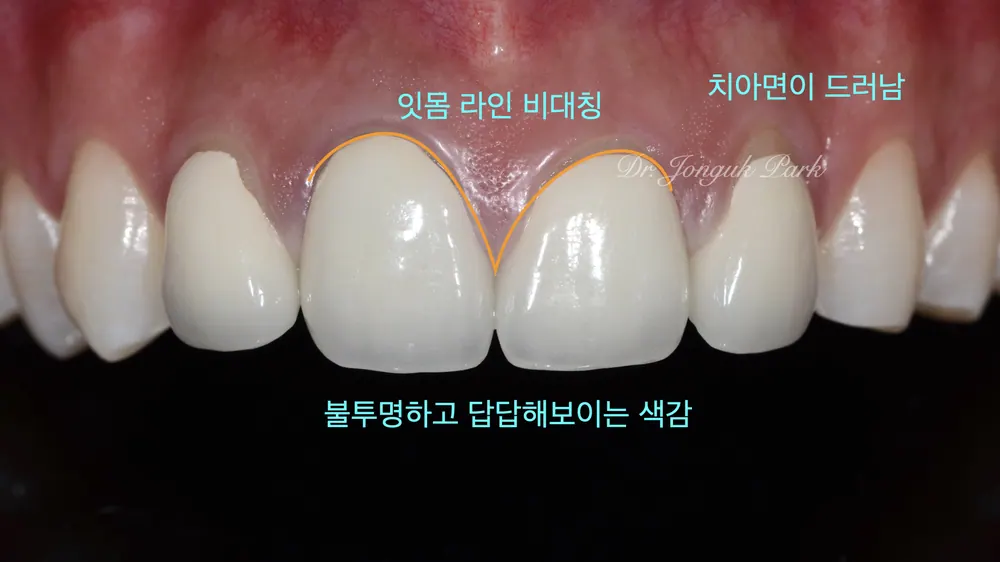 어색하고 부자연 스러운 라미네이트 재시술 하기 본문 사진 24