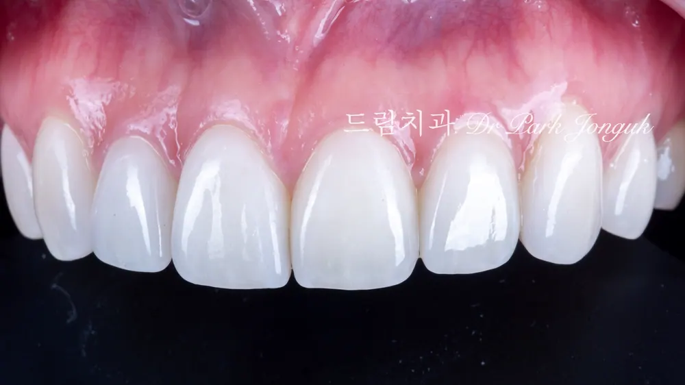 앞니 라미네이트 진단에서 치과의사의 역할! 본문 사진 8