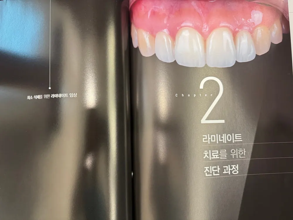최소삭제를 위한 라미네이트 임상 본문 사진 3