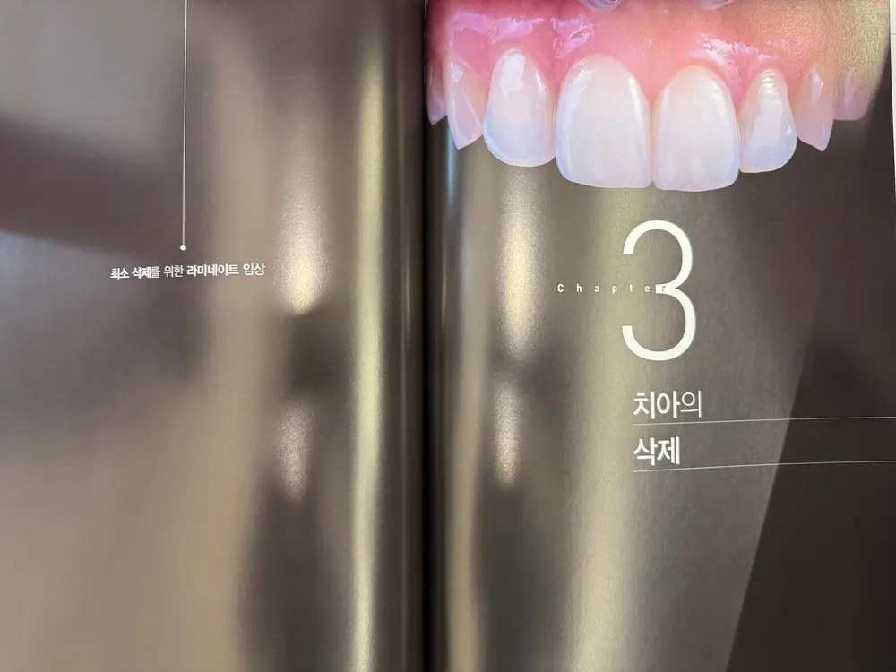 최소삭제를 위한 라미네이트 임상 본문 사진 4