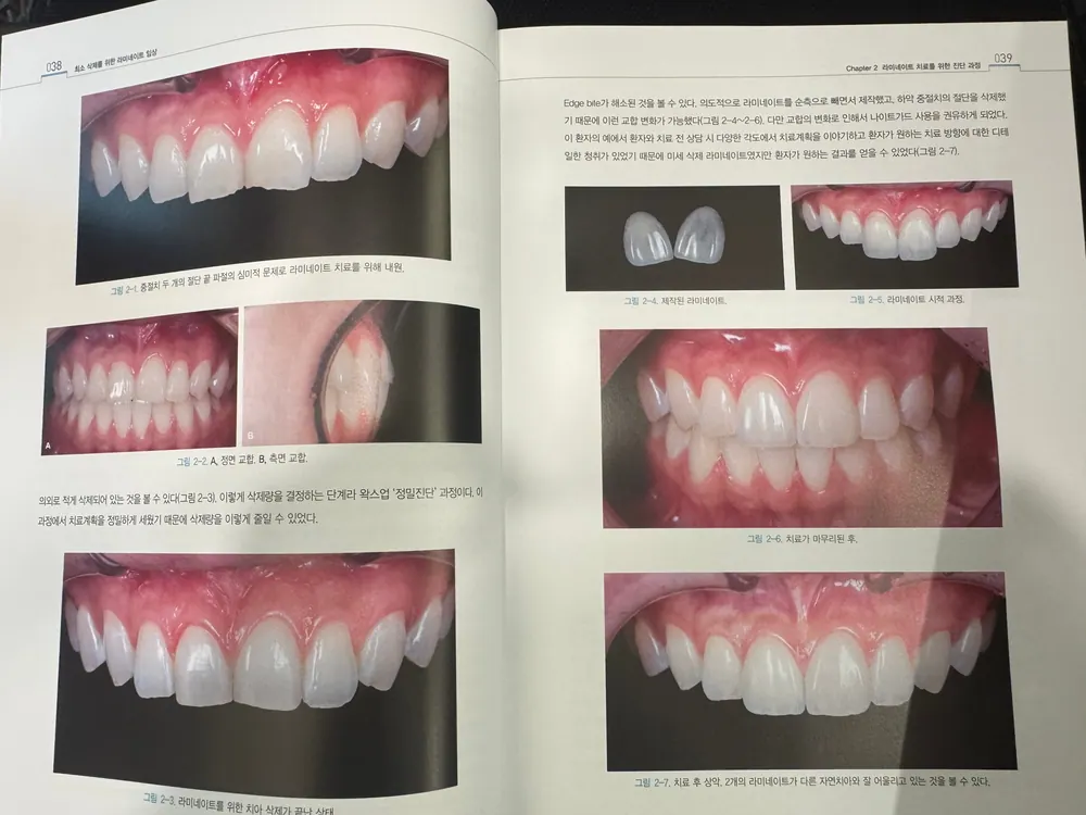 최소삭제를 위한 라미네이트 임상 본문 사진 5
