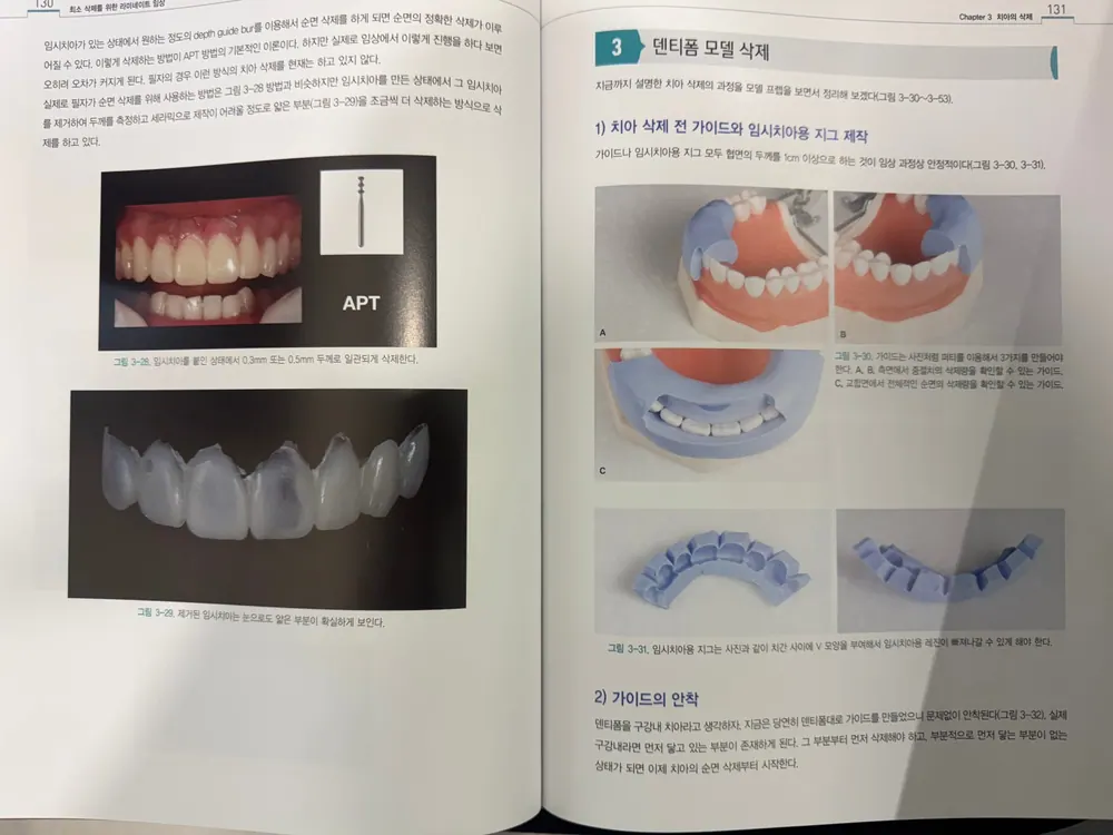 최소삭제를 위한 라미네이트 임상 본문 사진 6