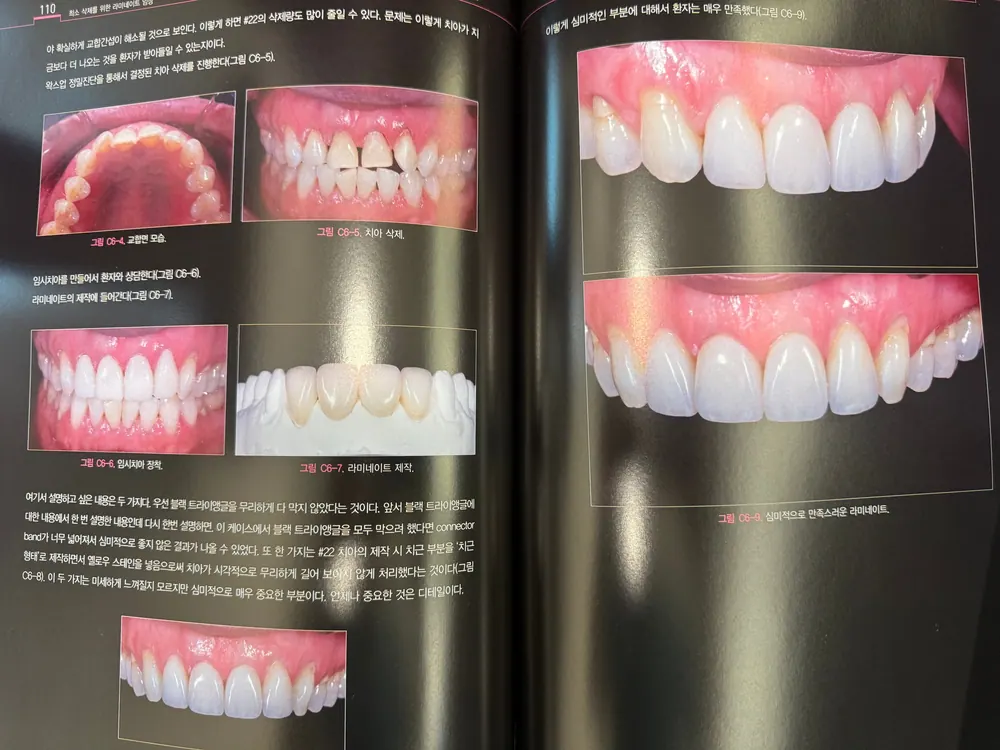 최소삭제를 위한 라미네이트 임상 본문 사진 7