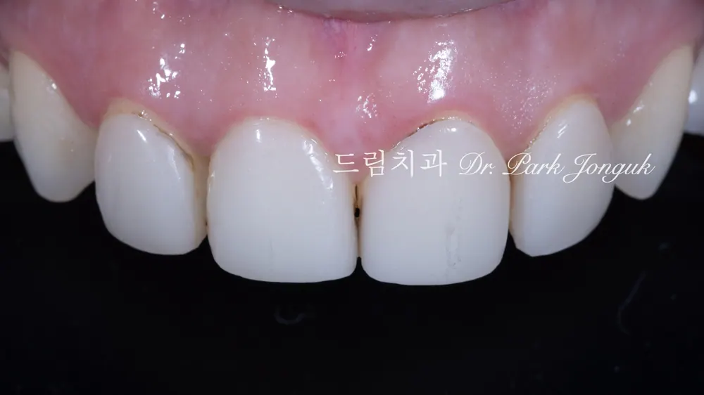 치아 손상 줄이면서 라미네이트 제거하는 법: 레이저 활용법 본문 사진 1