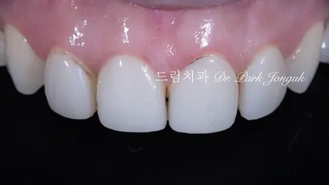 치아 손상 줄이면서 라미네이트 제거하는 법: 레이저 활용법