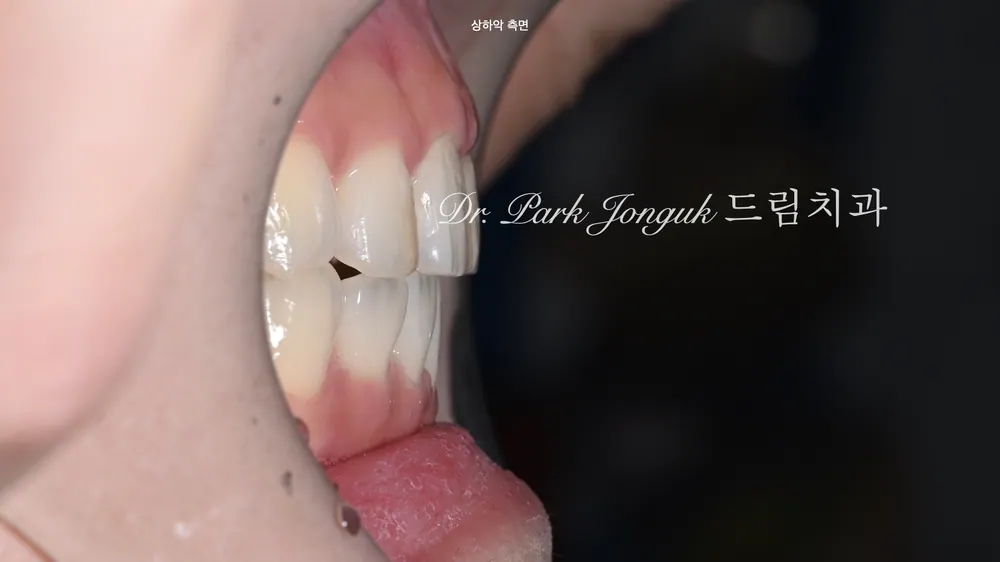 최소한의 삭제만으로 라미네이트 치료하기. 본문 사진 4
