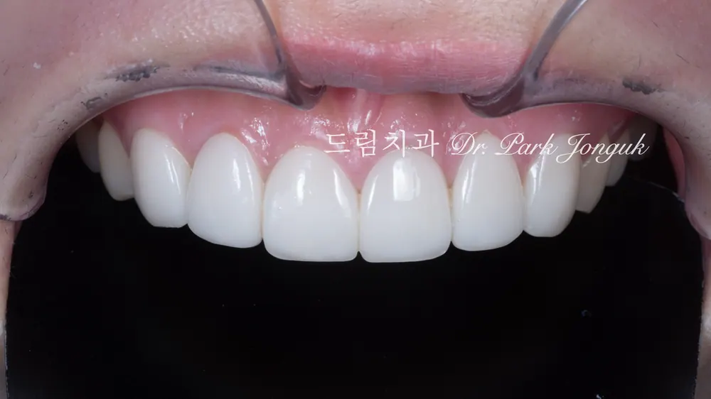 크고 어색한 라미네이트를 자연스럽고 작고 예쁜 치아로 재시술 본문 사진 1
