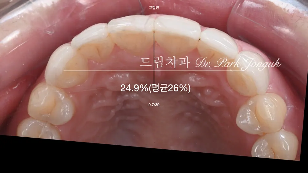 크고 어색한 라미네이트를 자연스럽고 작고 예쁜 치아로 재시술 본문 사진 3