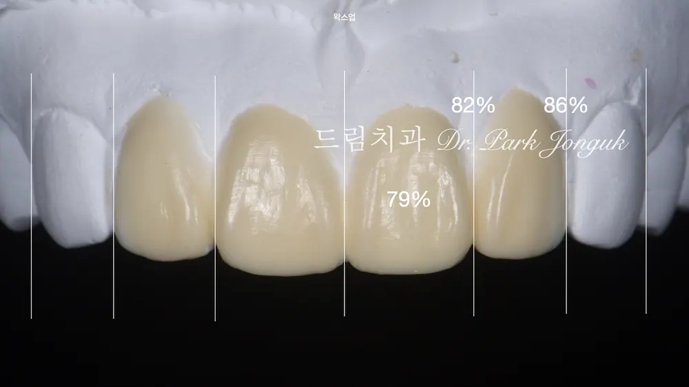 크고 어색한 라미네이트를 자연스럽고 작고 예쁜 치아로 재시술 본문 사진 4
