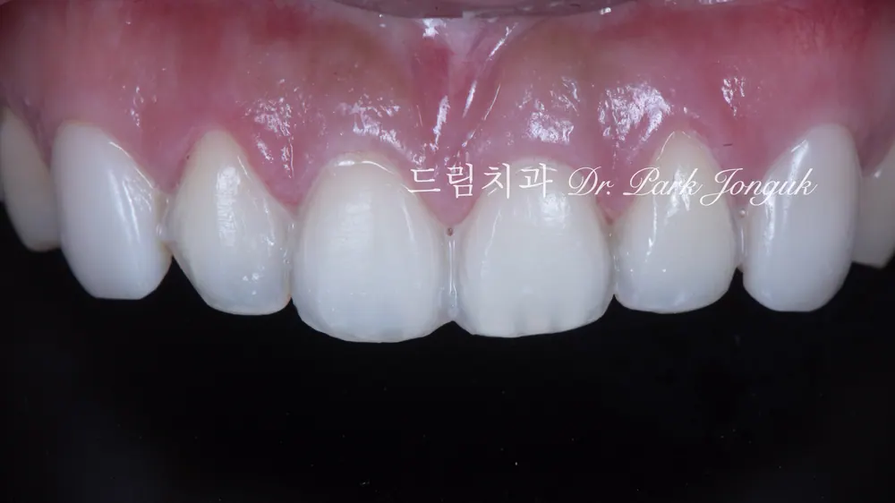 크고 어색한 라미네이트를 자연스럽고 작고 예쁜 치아로 재시술 본문 사진 6