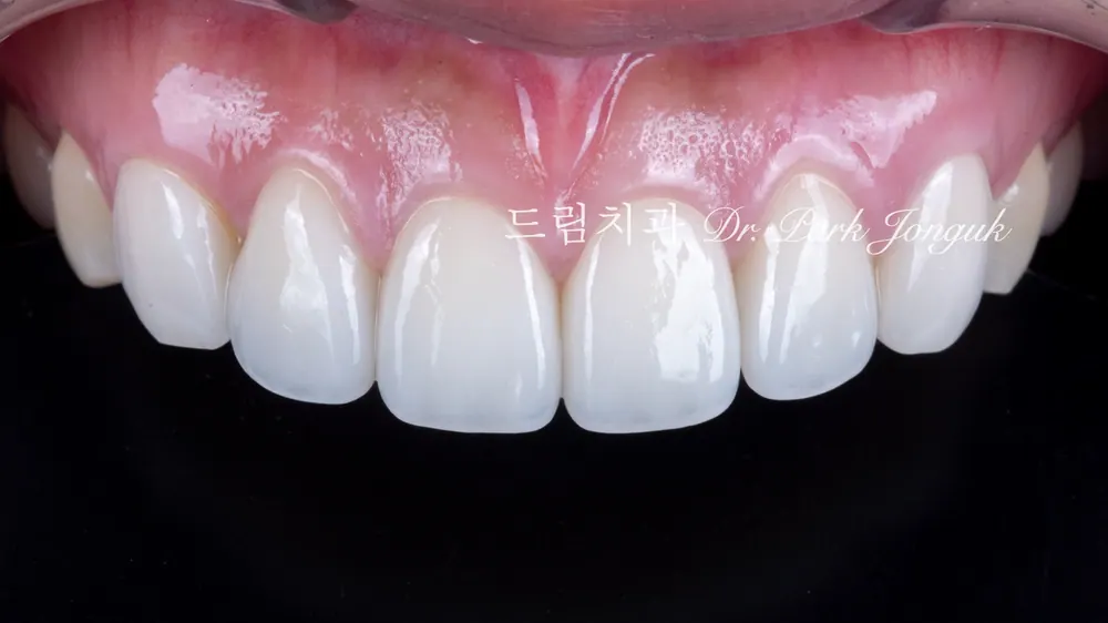 크고 어색한 라미네이트를 자연스럽고 작고 예쁜 치아로 재시술 본문 사진 7