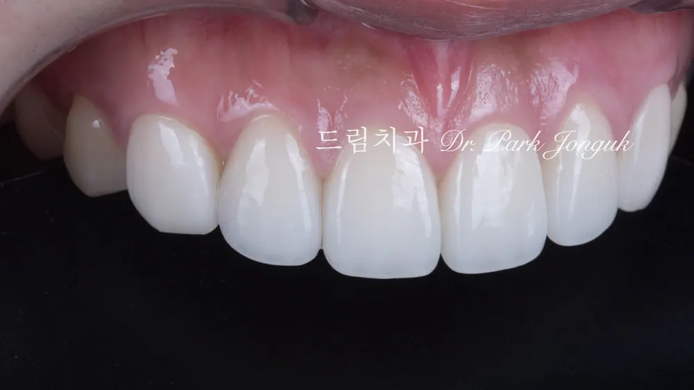 크고 어색한 라미네이트를 자연스럽고 작고 예쁜 치아로 재시술 본문 사진 8