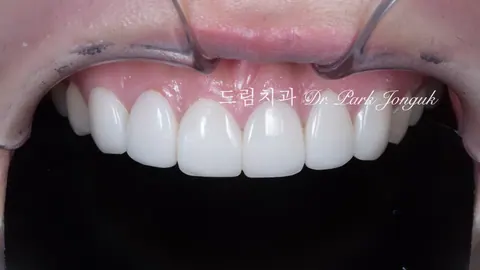 크고 어색한 라미네이트를 자연스럽고 작고 예쁜 치아로 재시술