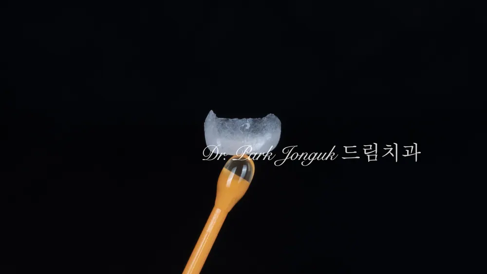 무삭제 라미네이트, 이렇게도 가능합니다! 본문 사진 2