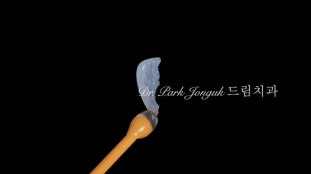 무삭제 라미네이트, 이렇게도 가능합니다! 본문 사진 3