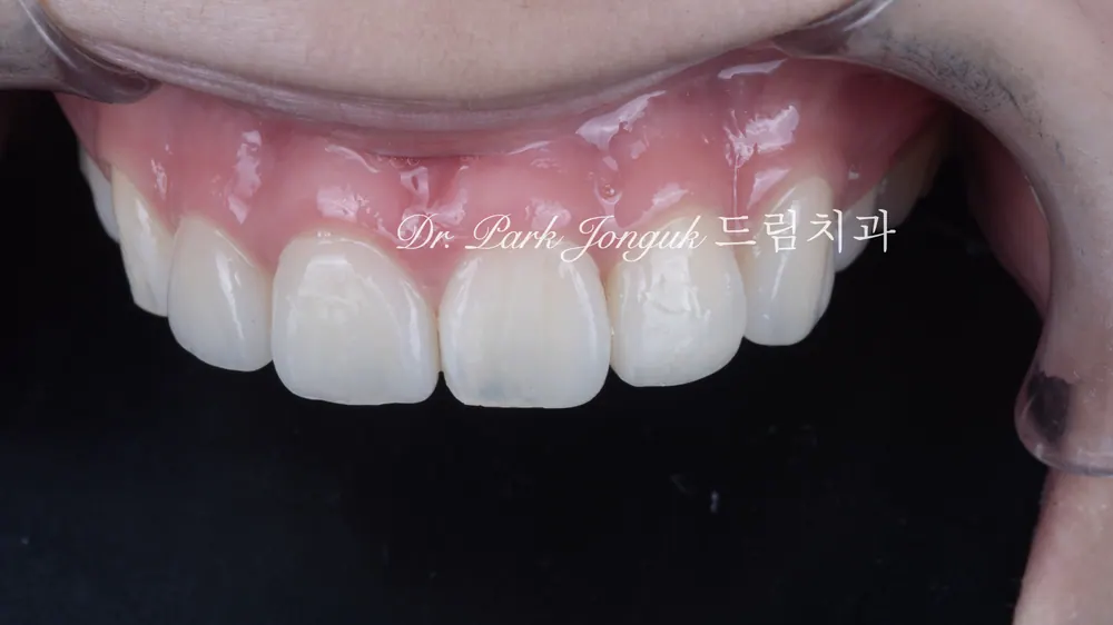 무삭제 라미네이트, 이렇게도 가능합니다! 본문 사진 6