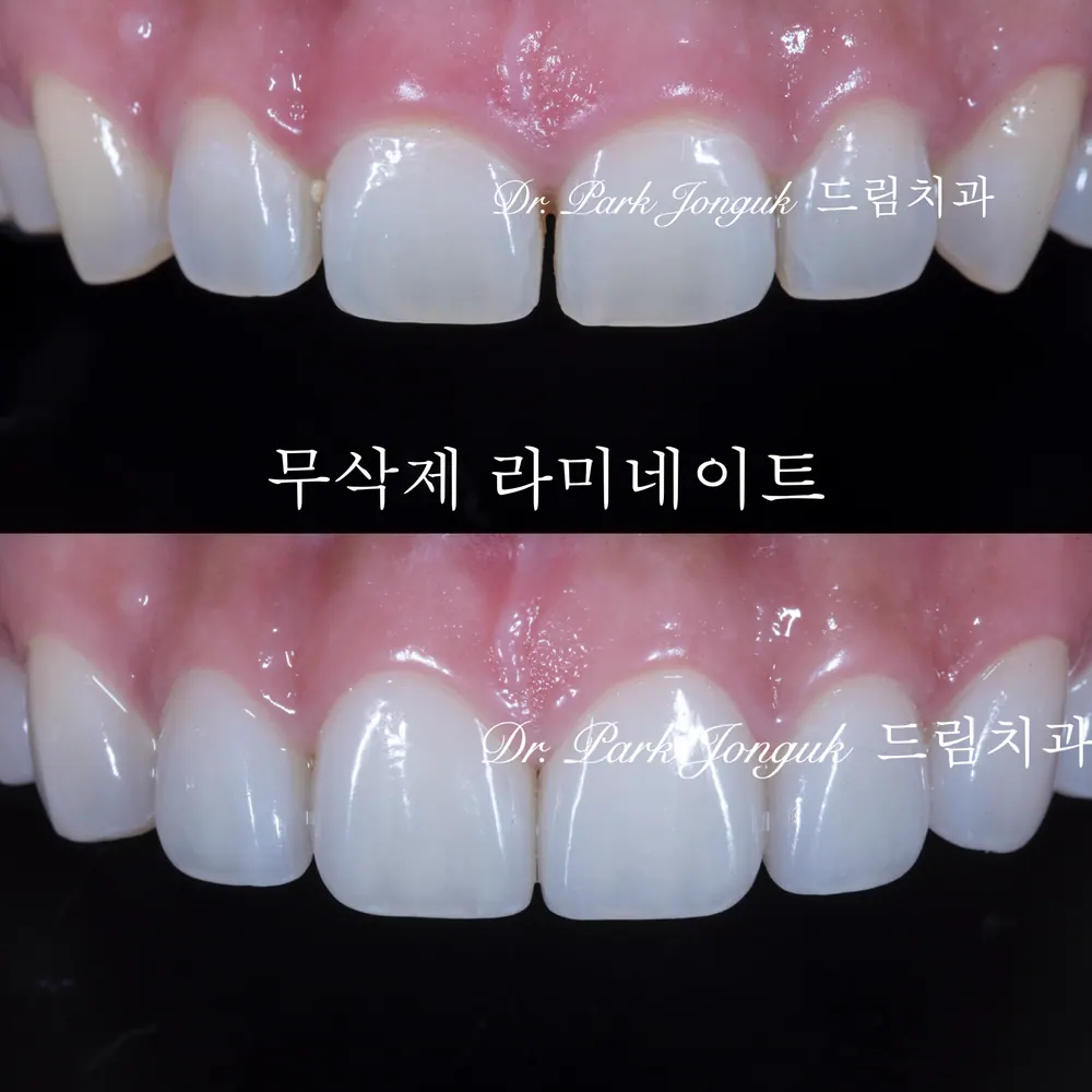 앞니 라미네이트 치료 전 꼭 알아야 할 것 본문 사진 1