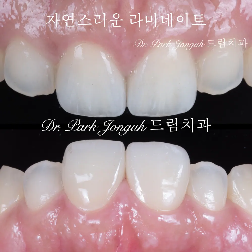 앞니 라미네이트 치료 전 꼭 알아야 할 것 본문 사진 2