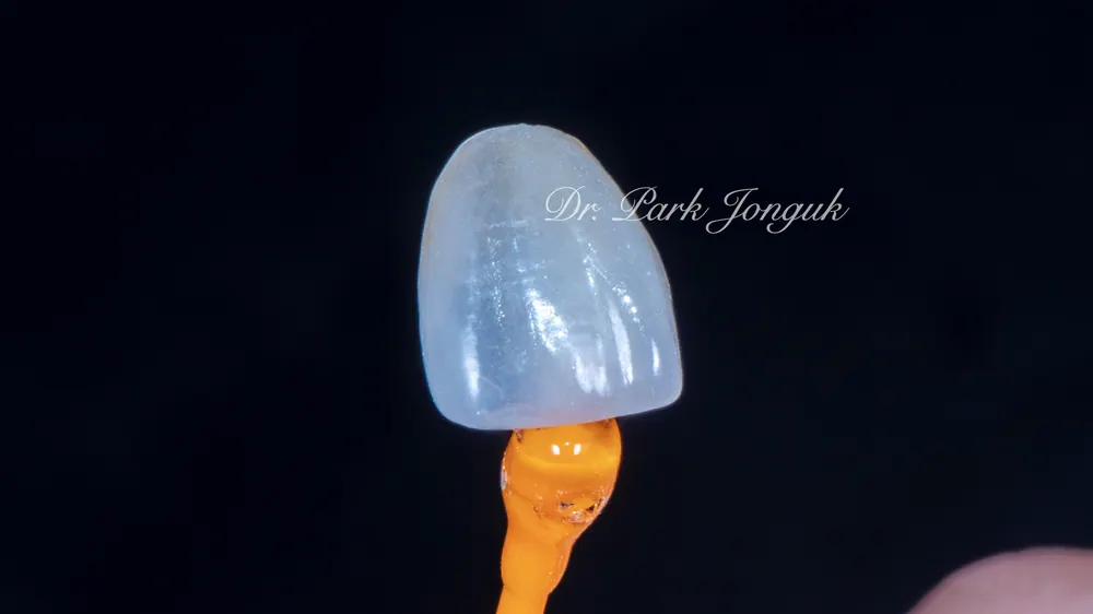 라미네이트 치료 전, 치과의사가 꼭 알려주고 싶은 이야기 본문 사진 5