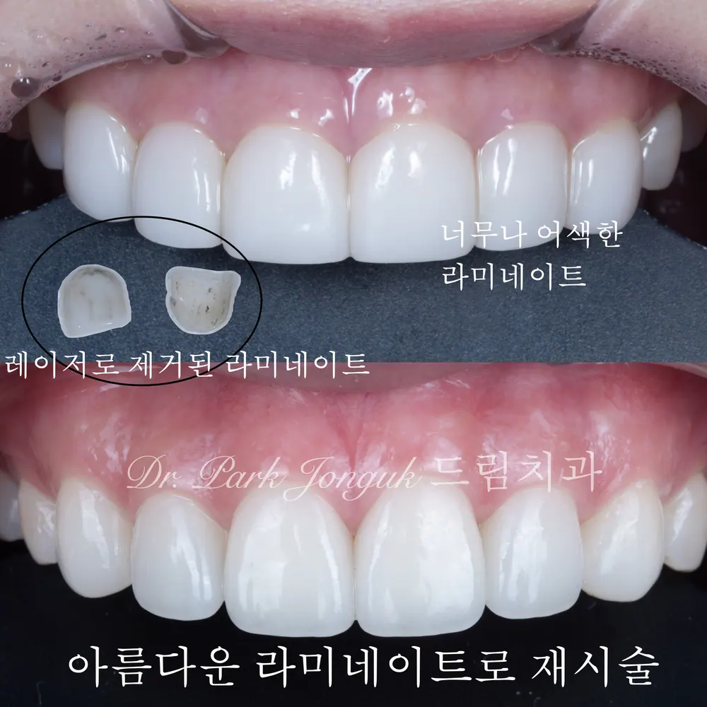 라미네이트 치료 전, 치과의사가 꼭 알려주고 싶은 이야기 본문 사진 11