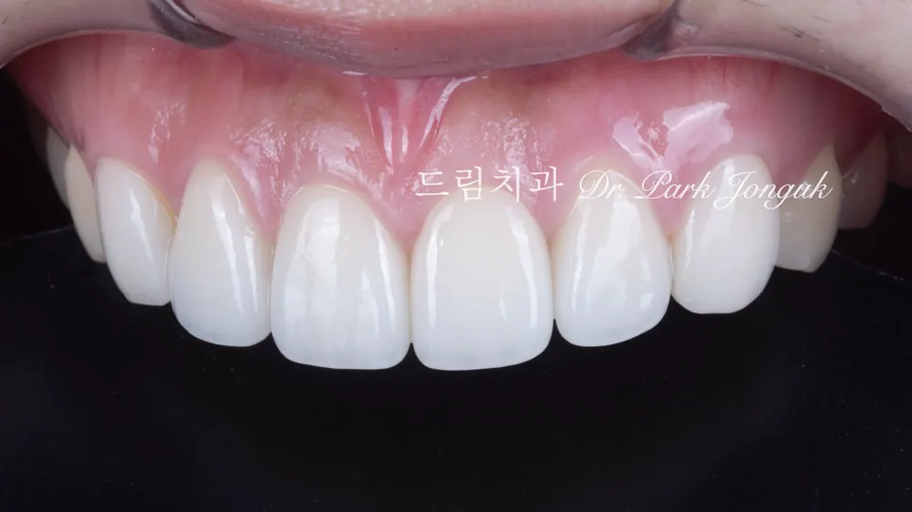 라미네이트 재시술 사례｜인공적인 원데이 라미네이트를 자연스럽게 다시 치료한 과정 본문 사진 9