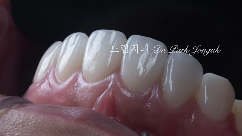 라미네이트 재시술 사례｜인공적인 원데이 라미네이트를 자연스럽게 다시 치료한 과정 본문 사진 10