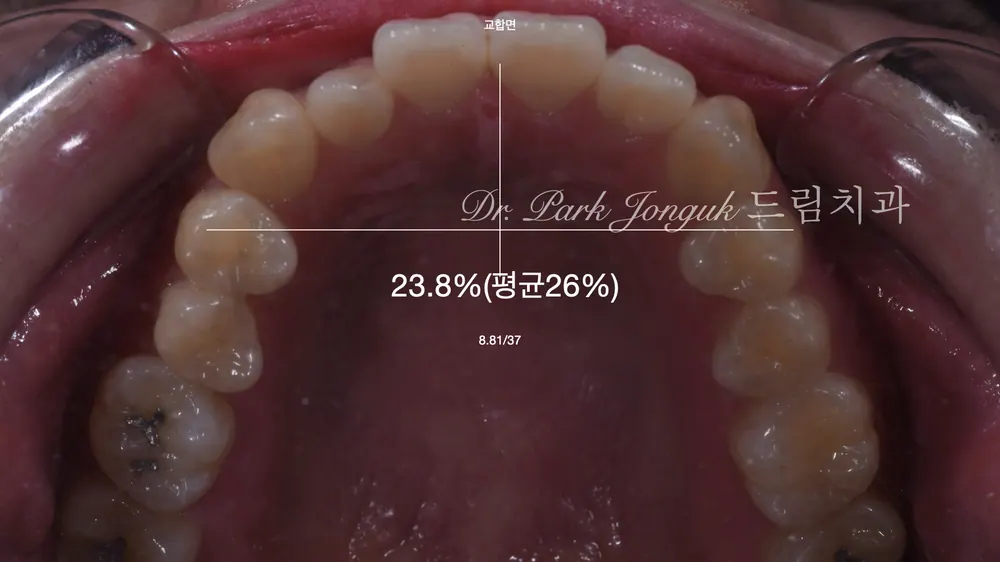 토끼이 앞니 라미네이트 치료｜최소삭제 정밀진단으로 자연스럽게 해결한 사례 본문 사진 4
