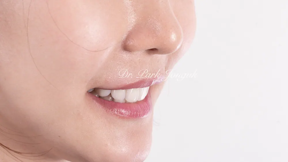 하얗고 어색한 앞니 라미네이트, 재시술로 자연스러운 투명 치아 완성 본문 사진 16