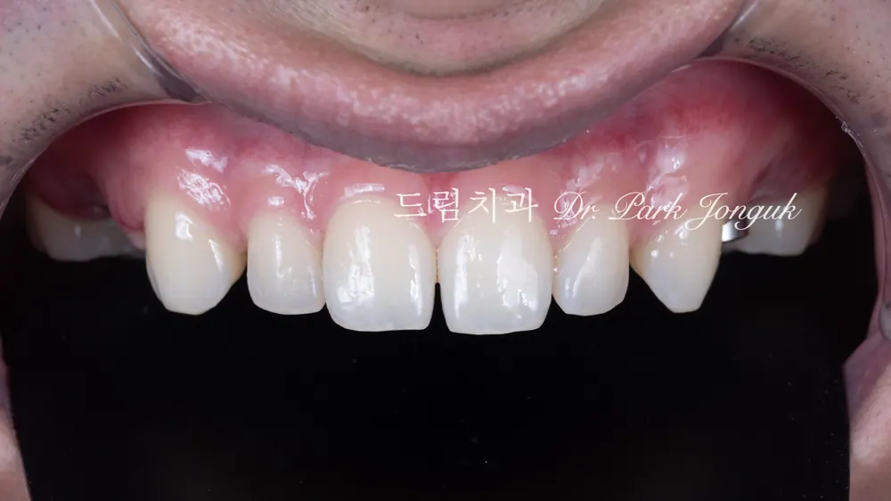 치아사이 공간과 왜소치의 무삭제 라미네이트