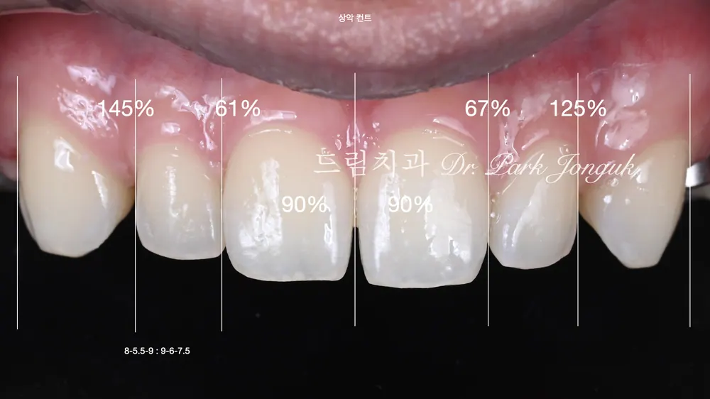 무삭제 라미네이트｜가능한 조건과 자연스러운 실제 사례 본문 사진 2