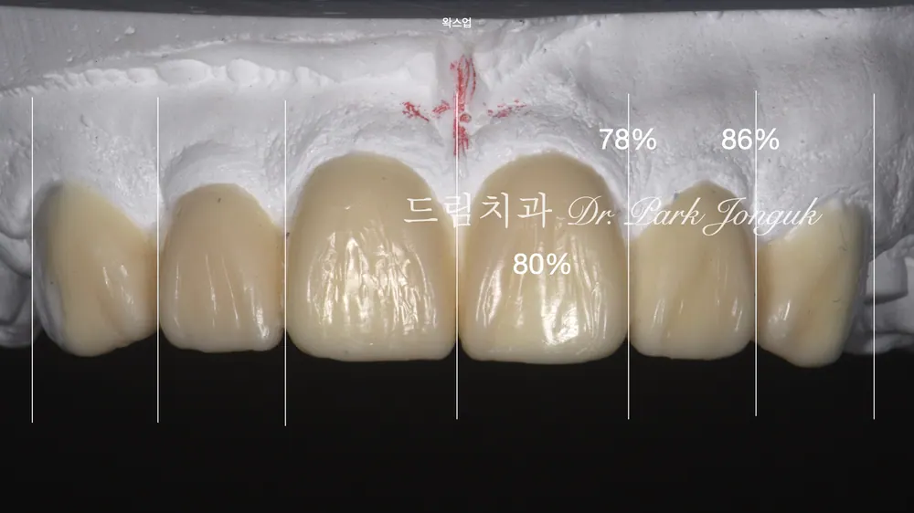 무삭제 라미네이트｜가능한 조건과 자연스러운 실제 사례 본문 사진 3