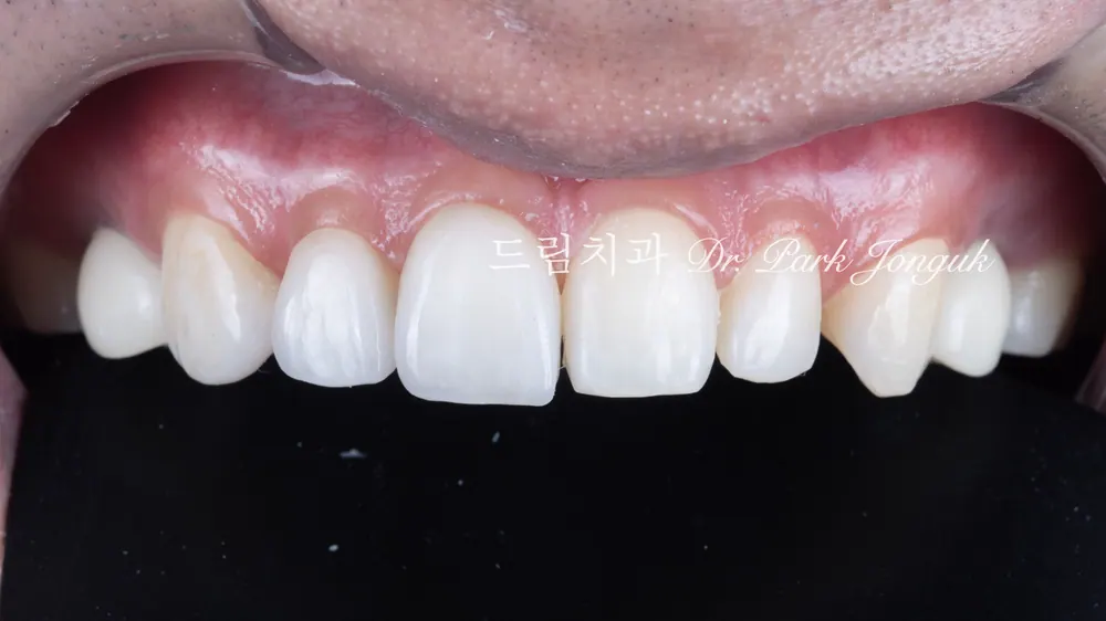 무삭제 라미네이트｜가능한 조건과 자연스러운 실제 사례 본문 사진 5