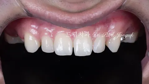 무삭제 라미네이트｜가능한 조건과 자연스러운 실제 사례