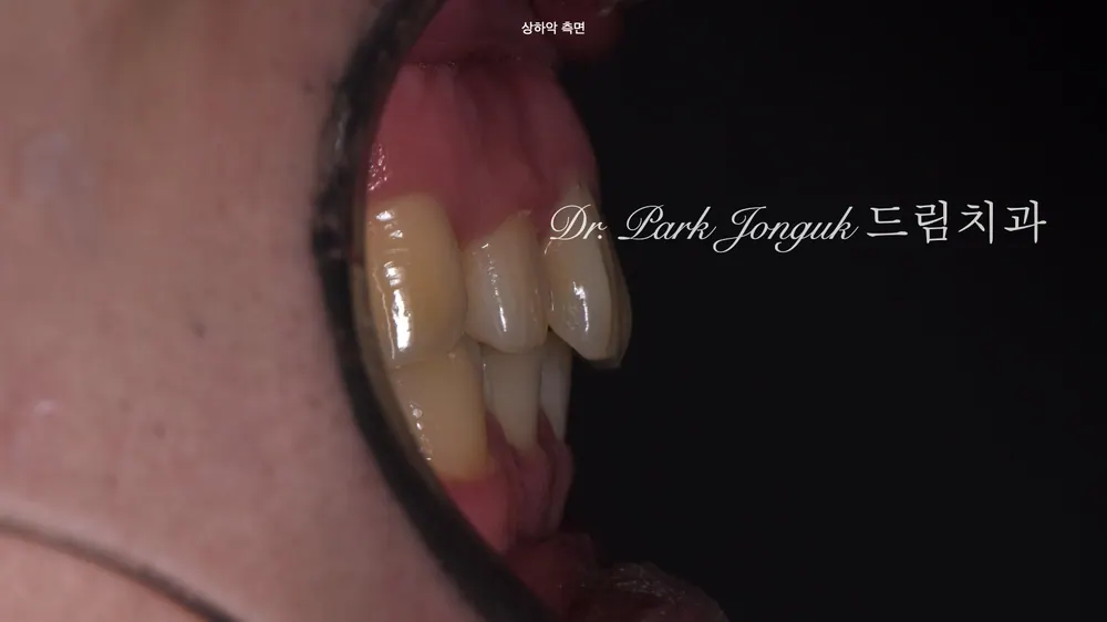 자연스러운 앞니 라미네이트｜벌어진 치아·토끼이·왜소치 치료 과정 본문 사진 3