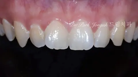 토끼이 앞니 라미네이트｜크고 어색한 치아, 자연스럽고 조화롭게 변화된 사례
