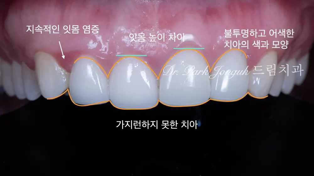 라미네이트 재시술 전 다양한 문제점