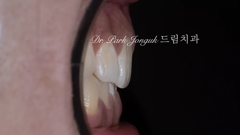 무삭제 라미네이트를 위해서는 옥니가 좋음