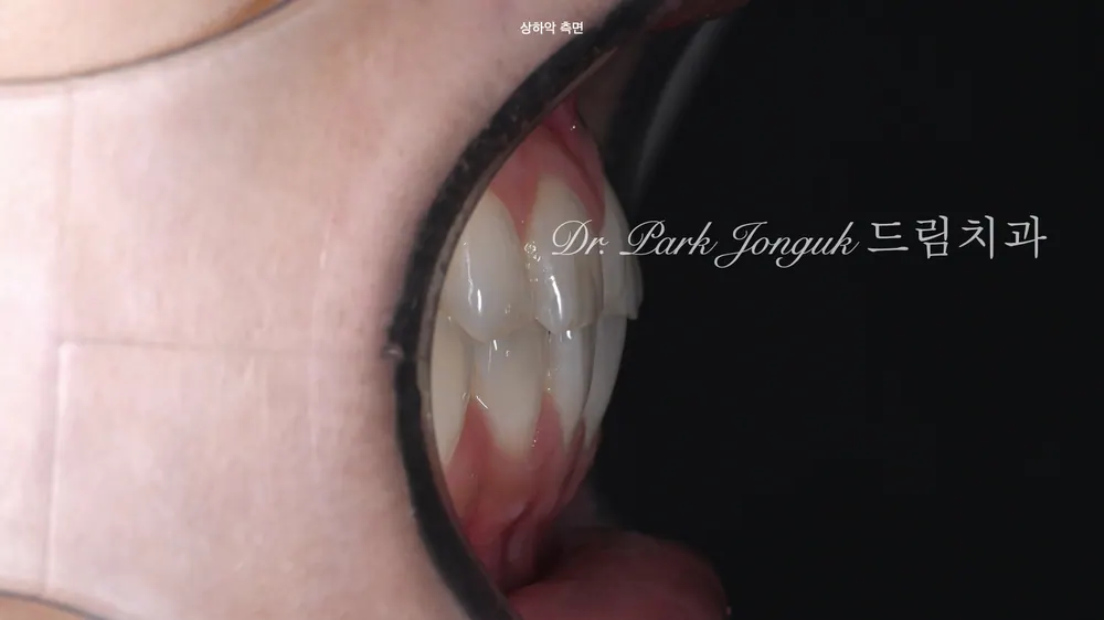 앞니 두 개만 라미네이트｜무삭제에 가까운 최소삭제로 자연스러운 복원 본문 사진 3
