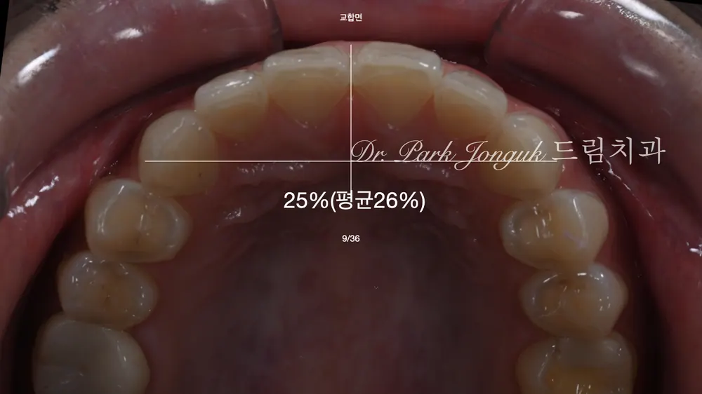 왁스업 정밀진단 for 무삭제 라미네이트