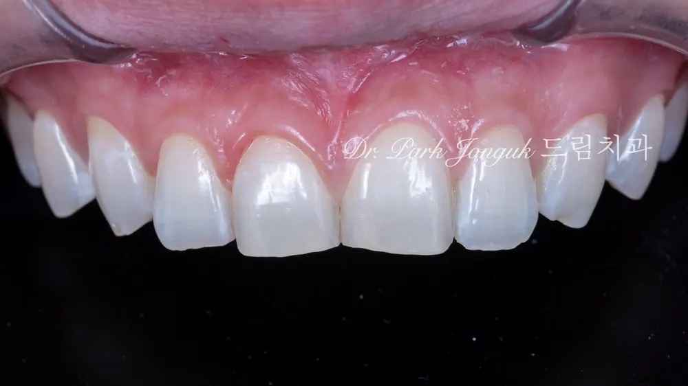 무삭제에 가까운 미세삭제 라미네이트