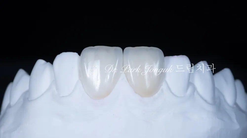 앞니 두 개만 라미네이트｜무삭제에 가까운 최소삭제로 자연스러운 복원 본문 사진 8