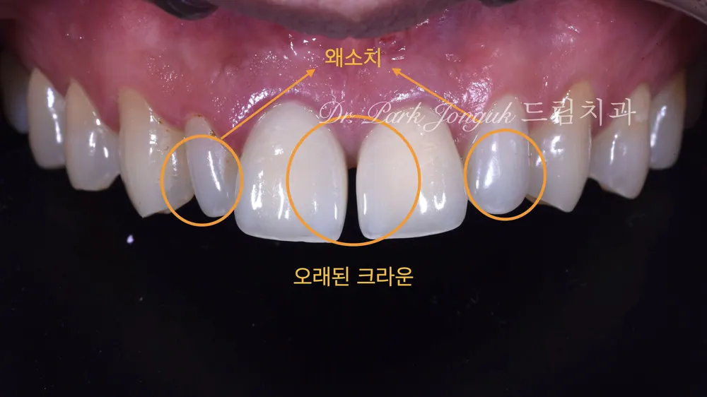 PFM 크라운과 왜소치