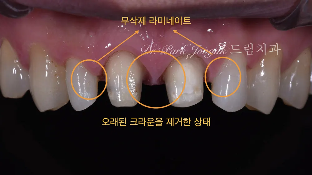 PFM 크라운 제거후