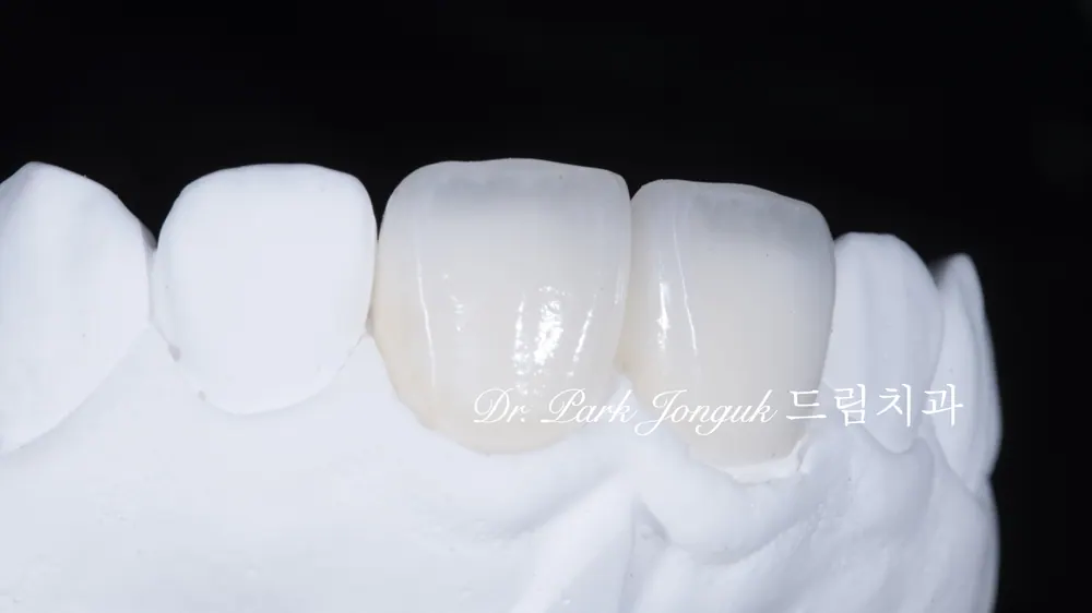 라미네이트 재시술｜어색했던 앞니를 자연스러운 라미네이트로 다시 완성한 케이스 본문 사진 8