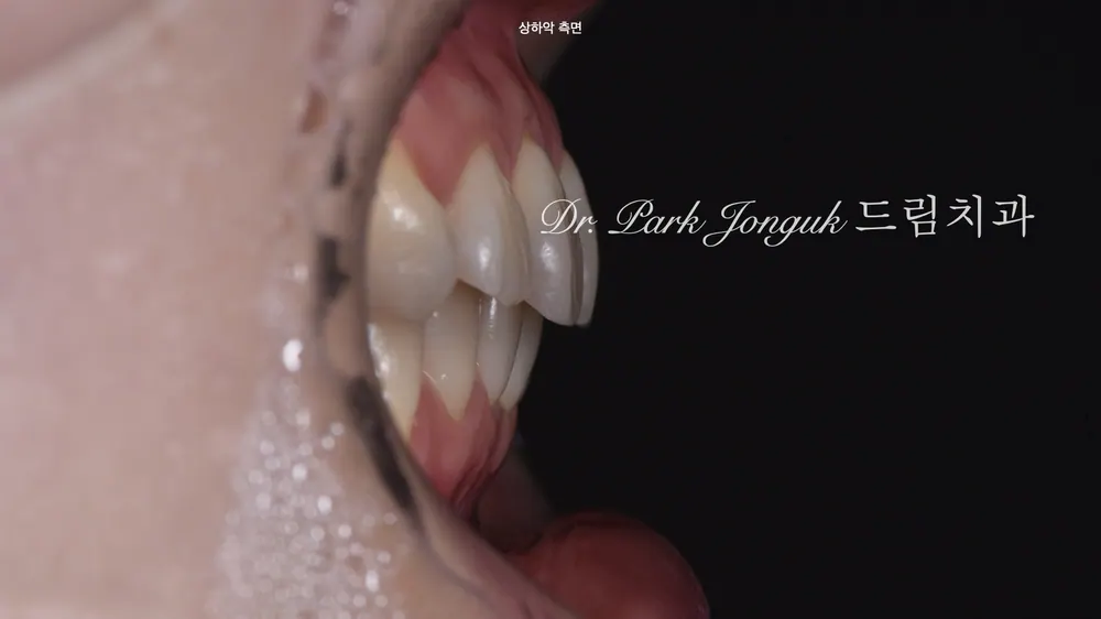 어두운 변색치, 자연스럽게 밝히는 방법｜변색치아 라미네이트의 정답 본문 사진 4