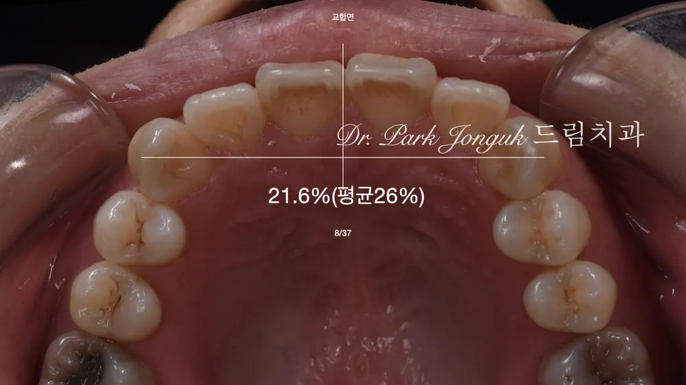 라미네이트를 위한 왁스업 정밀진단